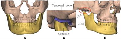 3D Printing Experimental Validation of the Finite Element Analysis of the Maxillofacial Model